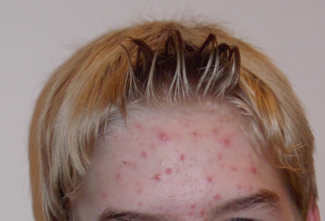 Acne is a dermatological expression that includes blocked pores, pimples, lumps or cysts