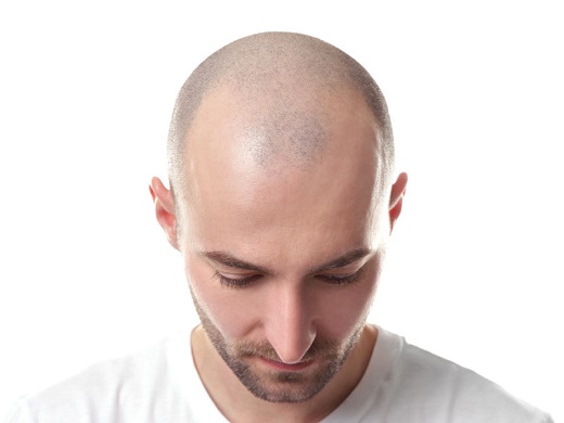 Hair Loss - Common Hair Loss Causes #FrizeMedia