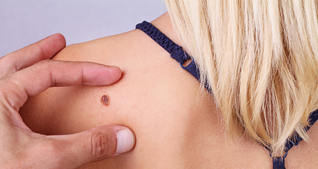 Early detection is key because, if diagnosed soon enough, skin cancer is almost always curable.